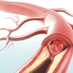 Stress Impacts Arterial Health