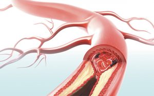 Stress Impacts Arterial Health
