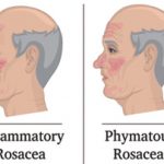 rosacea awareness