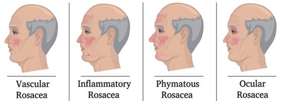 rosacea awareness