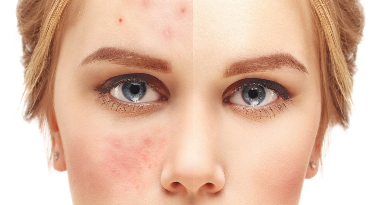 Acne Treatment