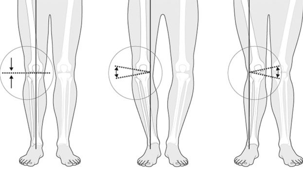 Foot Shape