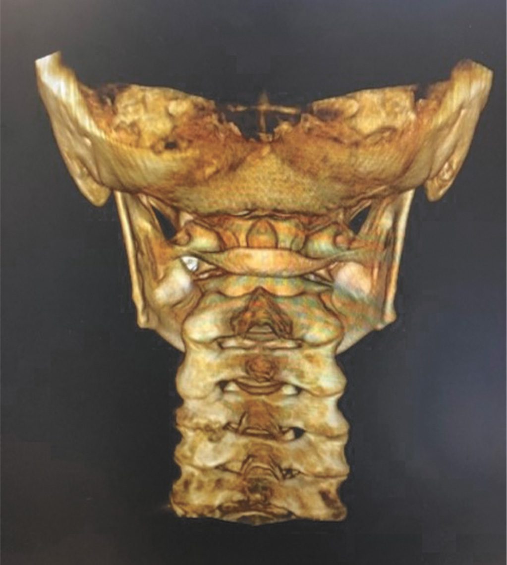 Natural Solution for Vertigo