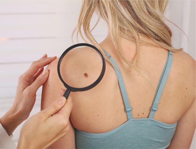 Skin Cancer