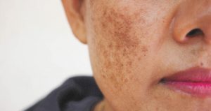 Melasma