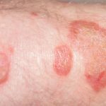 Psoriasis