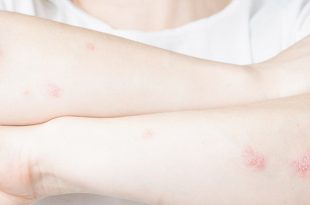 Psoriasis