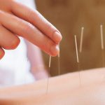 Acupuncture