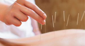 Acupuncture