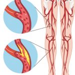 Peripheral Arterial Disease