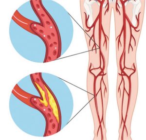 Peripheral Arterial Disease 