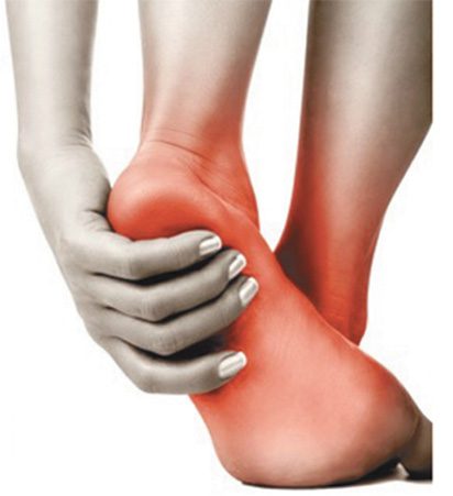 Plantar Fasciitis