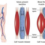 Venous Insufficiency