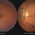 Diabetic Retinopathy