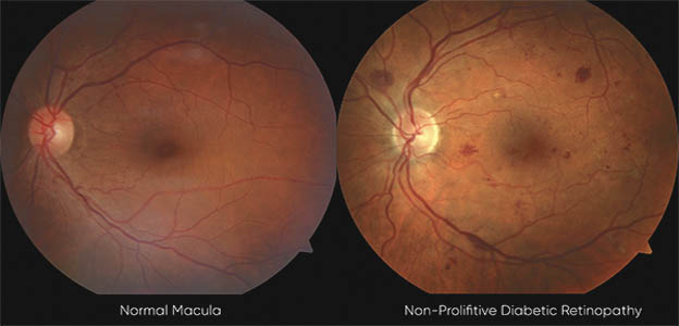 Diabetic Retinopathy: Causes, Symptoms, Treatment • Southwest Florida's ...