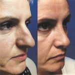 rhinoplasty