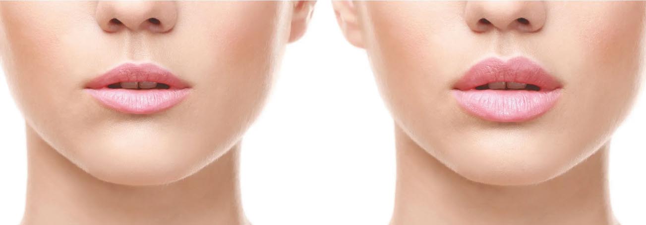 Lip Filler