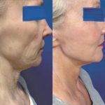 neck lift