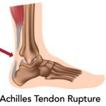 Achilles Tendon