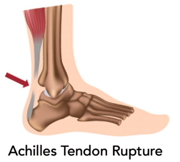 Achilles Tendon Ruptures and Getting You Back in the Game • Southwest ...