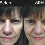 Blepharoplasty