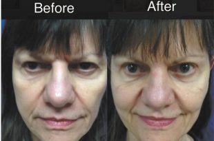 Blepharoplasty