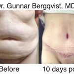 Abdominoplasty