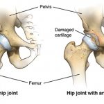 Hip Pain