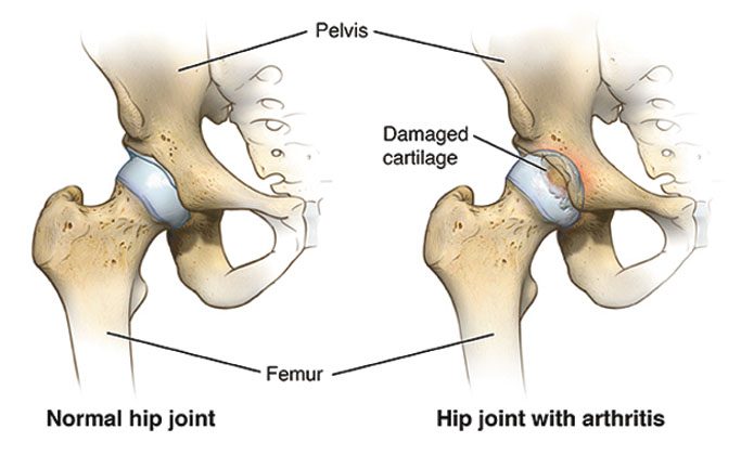 Hip Pain