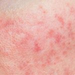 Rosacea