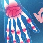 Arthritis Pain