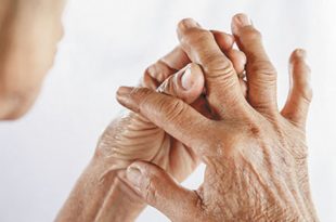 Rheumatoid Arthritis