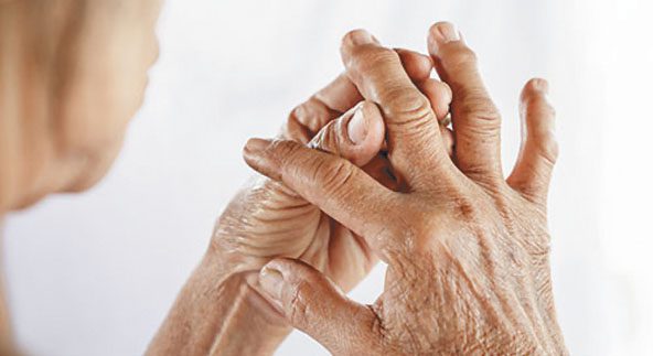 Rheumatoid Arthritis