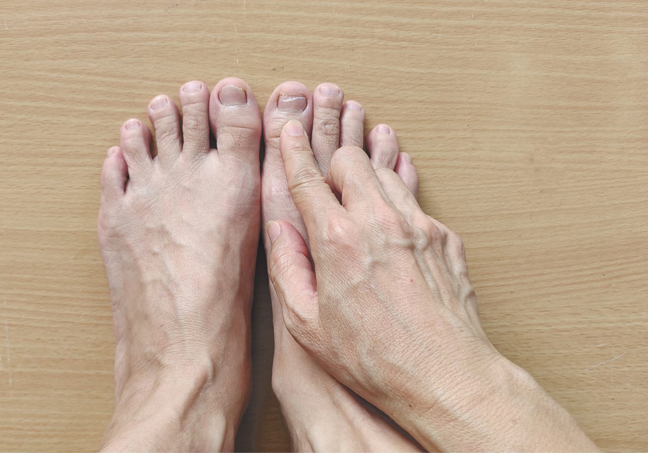 Ingrown toenails