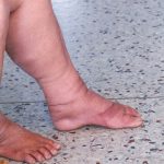 Lymphedema