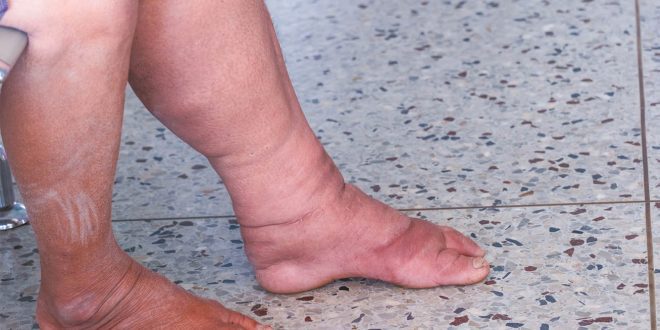 Lymphedema and Vein Disease