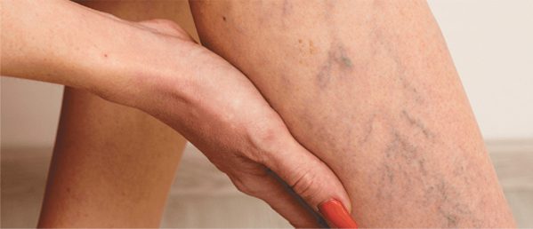 Sclerotherapy