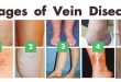 Complications of Vein Disease