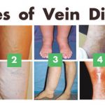 Vein Disease