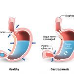 Gastroparesis