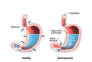 Gastroparesis