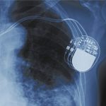 CARDIAC IMPLANT DEVICES