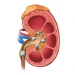 Kidney Stones