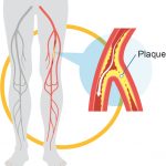 Peripheral Vascular Disease