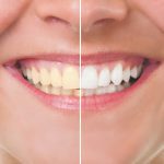 Tooth Whitening