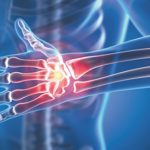 Understanding Arthritis