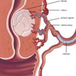 Uterine Fibroid