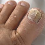 nail fungus