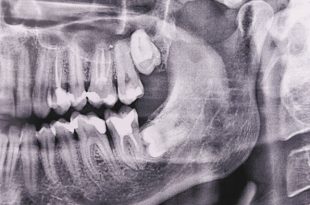Dental Radiation