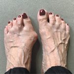 Bunions